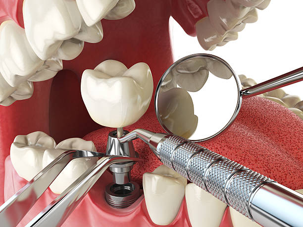 Best Emergency Dentist for Knocked-Out Tooth in Toulon, IL
